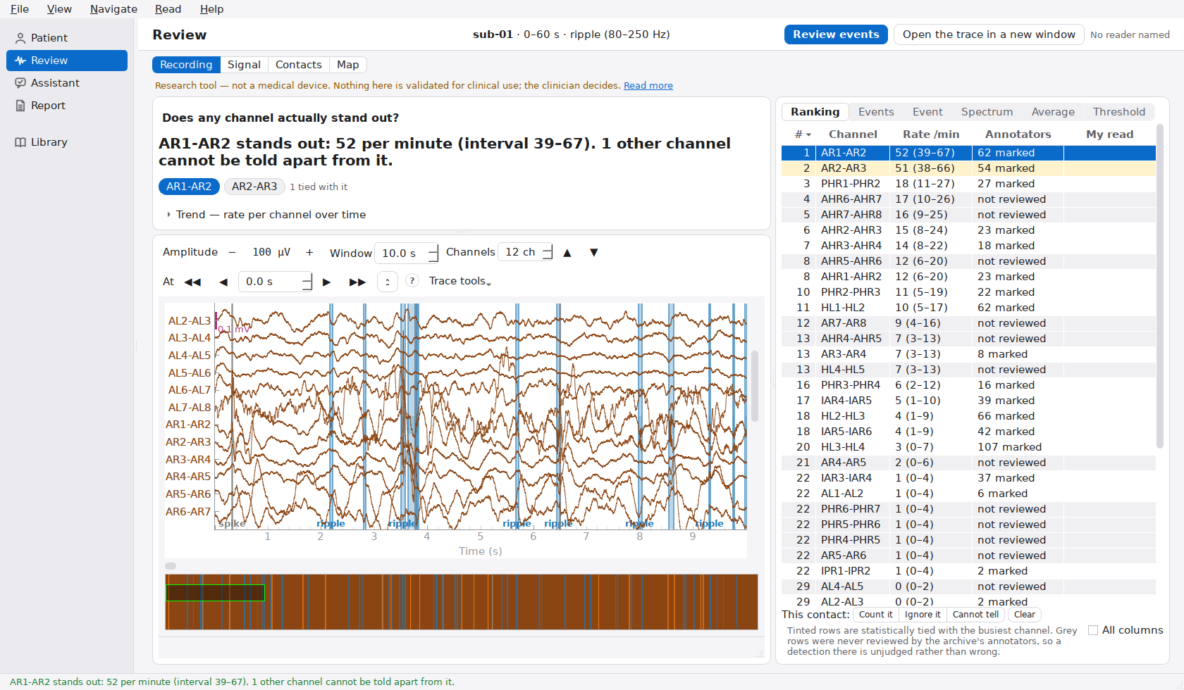 The Onset Review main window: a summary sentence stating that channel AR1-AR2 stands out at 52 events per minute with its interval and that one other channel cannot be distinguished from it; the intracranial EEG trace; and a channel table with rates, intervals and the reference markings' counts.