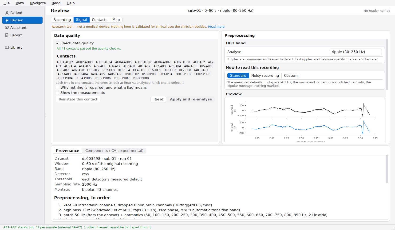 The Signal page: data-quality findings, preprocessing presets and a before-and-after filter preview.